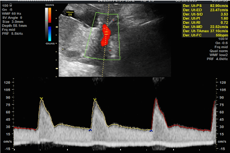 Ecografía de Alta Resolución y Doppler fetal