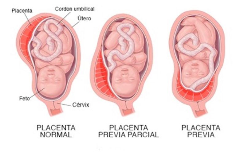 Placenta parcial, previa parcial y previa